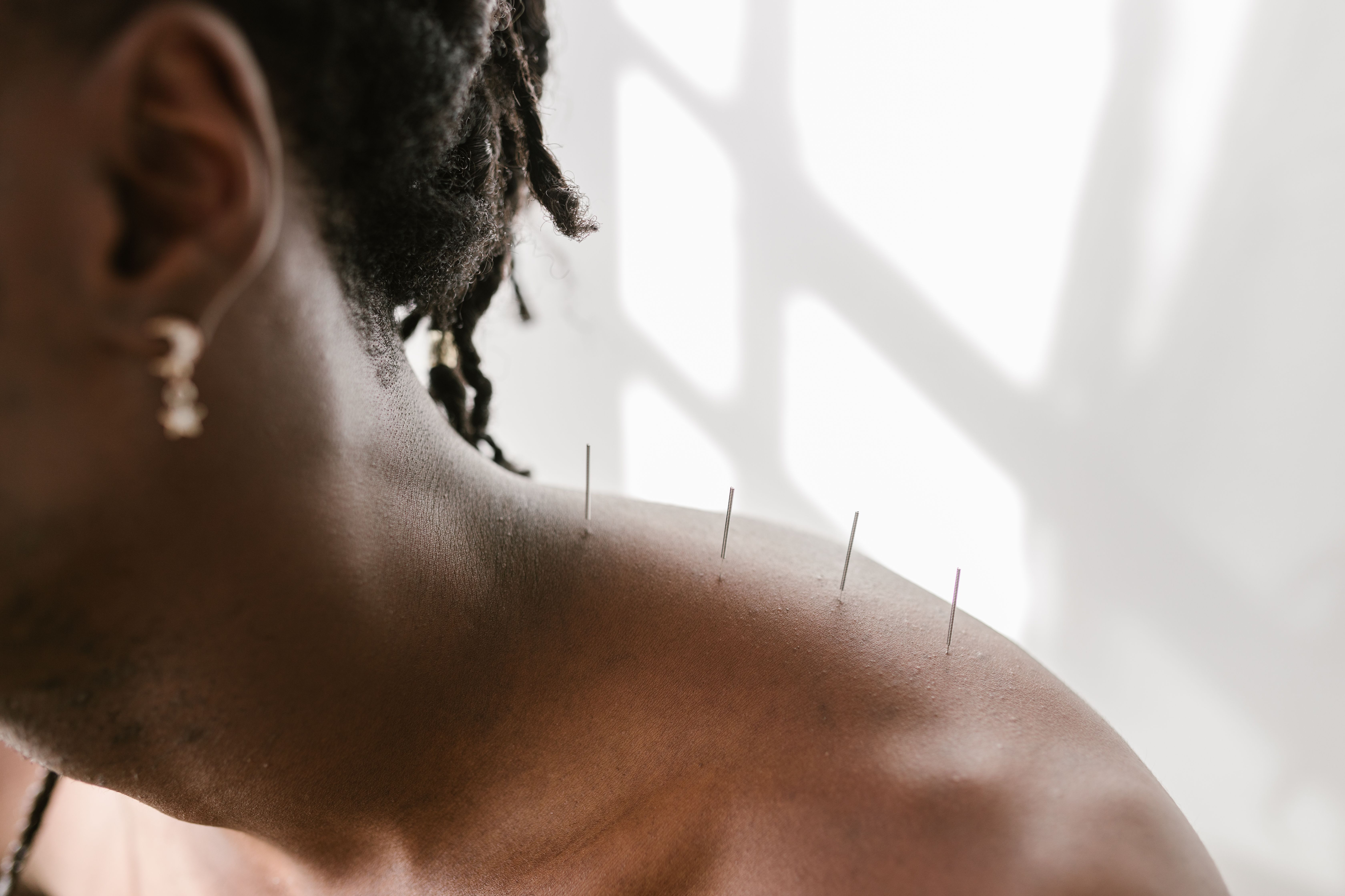Woman receiving acupuncture